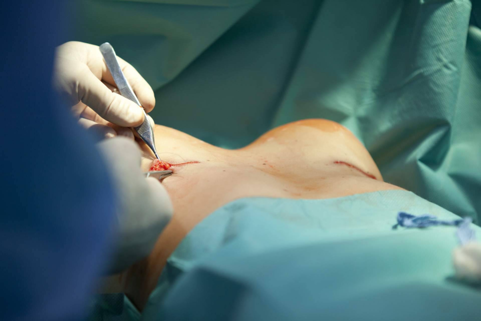 La cirugía de reducción de pecho puede ayudar a mejorar la calidad de vida, con A2Clinic
